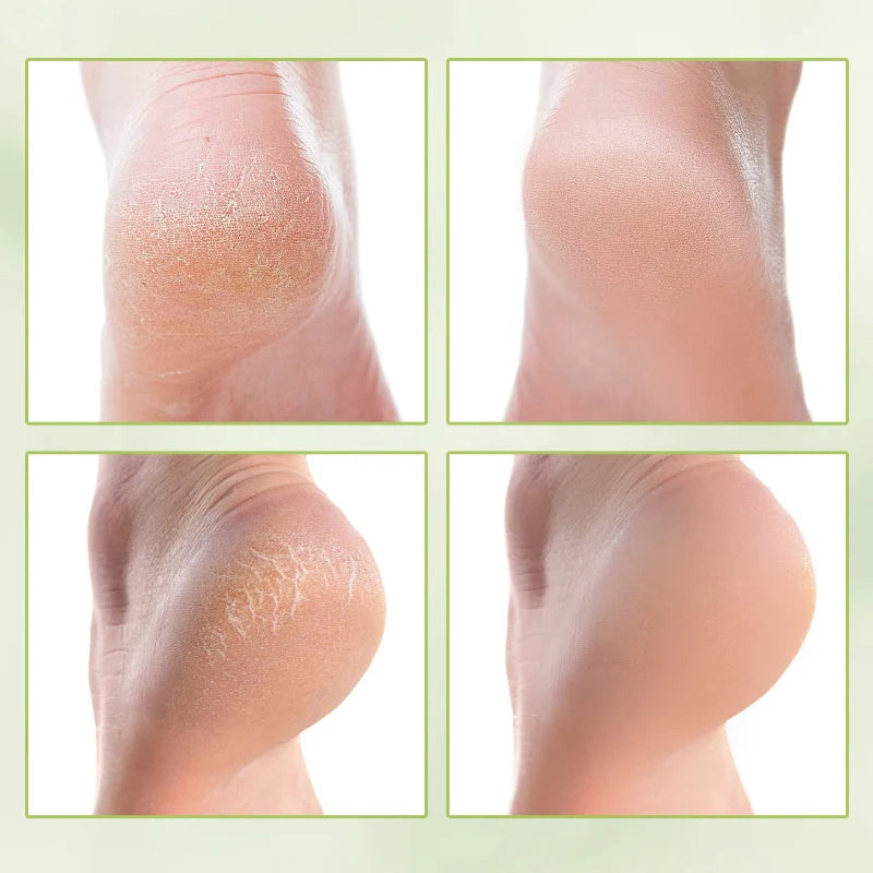 Urea Coconut Oil Foot Cream