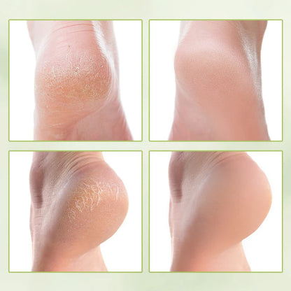 Urea Coconut Oil Foot Cream