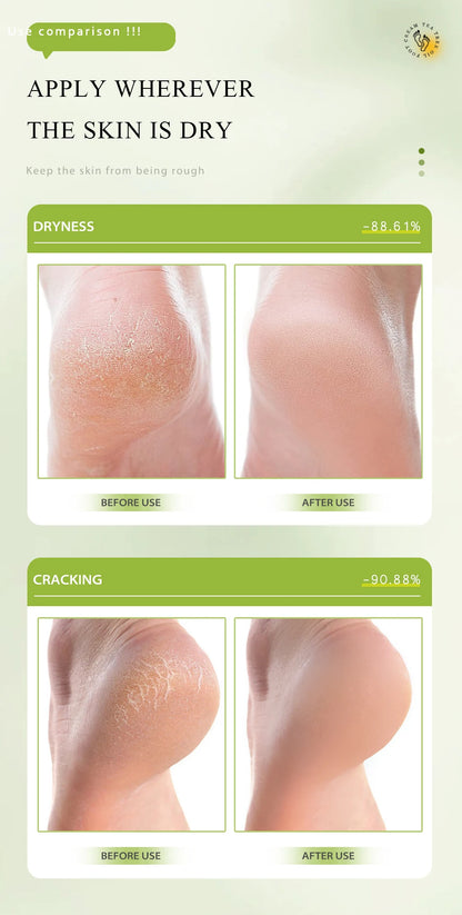 Urea Coconut Oil Foot Cream